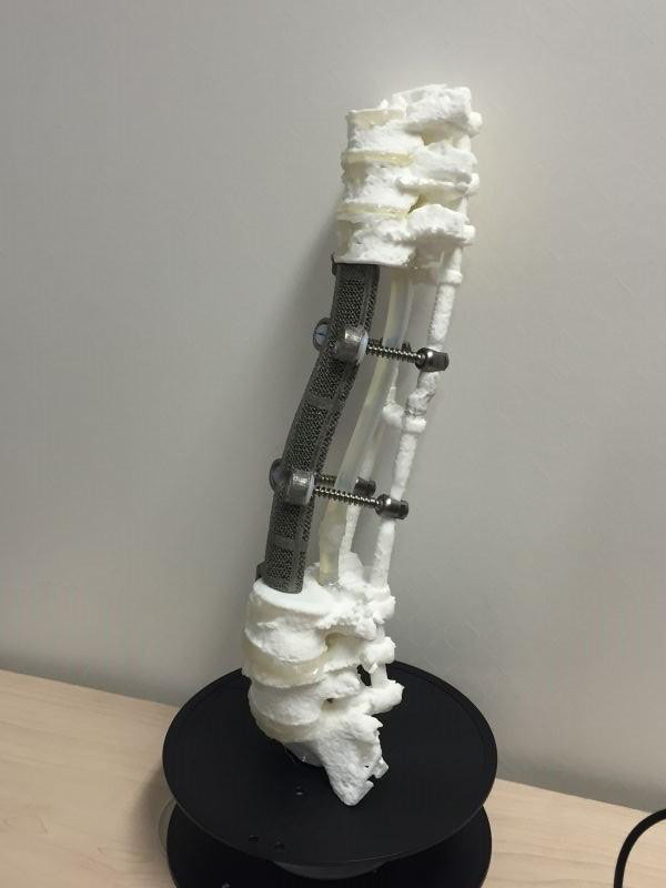 3D打印醫療應用成功案例 北醫三院3D打印定制人工椎體植入術