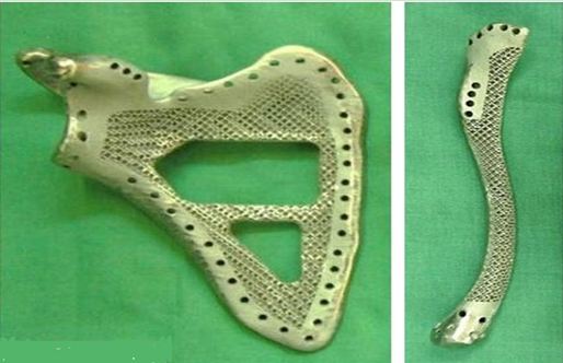 3d打印應用領(lǐng)域之醫(yī)療應用_e鍵打印服務公司