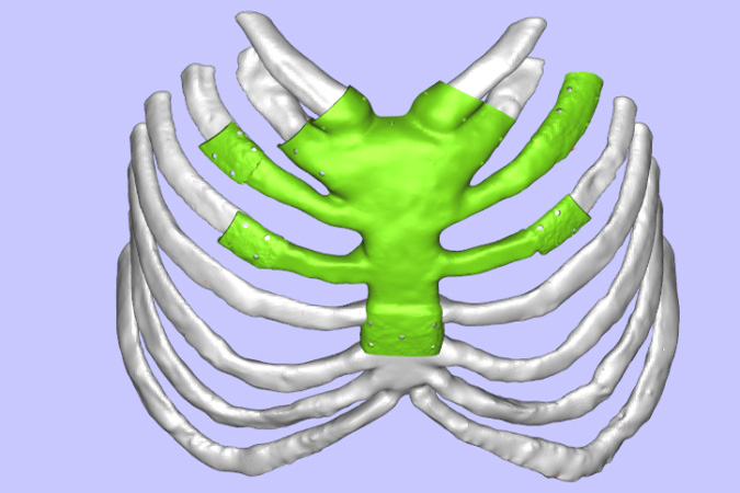 骨科3D打印
